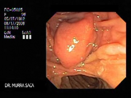 Acute Suppurative Cholangitis (1 of 8)