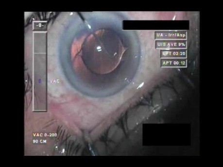 Cataract Surgery XII - Part 5