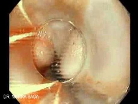 Upper GI Bleeding Due to Esophageal Varices - Banding of Varices, Part 1
