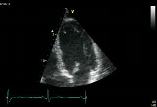 4 Chambers  Normal Study (Apical View)