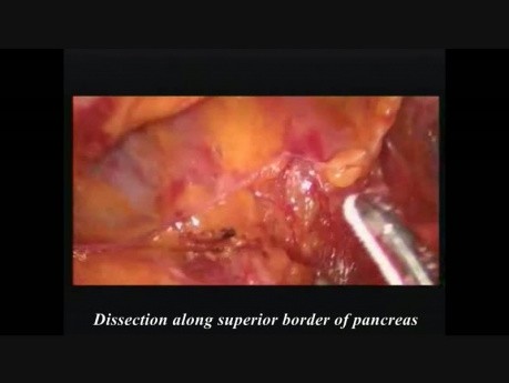 Laparoscopic Subtotal Pancreatectomy for Mucinous Cystadenoma