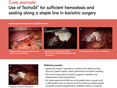 Use of TachoSil® in Bariatric Surgery for Sufficient Hemostasis and Sealing in Laparoscopic Sleeve Gastrectomy