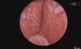 PVP - Vaporization of Highly Vascular Prostate