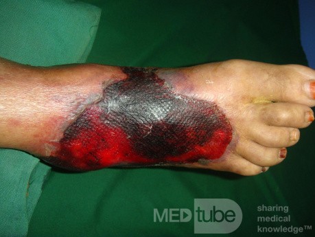 Diabetic foot - hemorrhagic bollus - tight bandage 