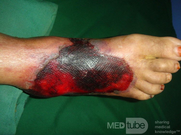 Diabetic foot - hemorrhagic bollus - tight bandage 