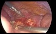Laparoscopic appendectomy - pregnant woman