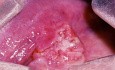 Sublingual Squamous Cell Carcinoma