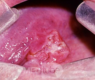 Sublingual Squamous Cell Carcinoma