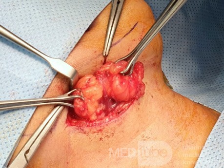 Submandibular Lipoma