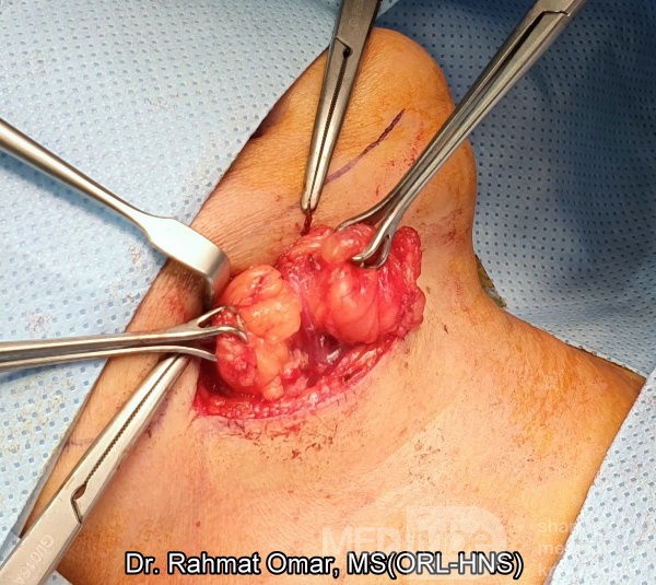 Submandibular Lipoma