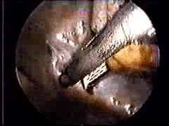 Appendix Removal Surgery