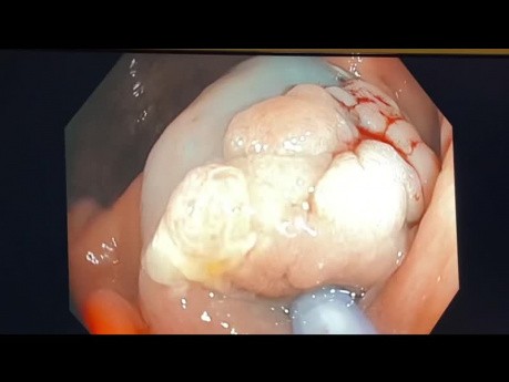 EMR Small Flat Polyp Cecum