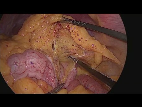 Splenic Flexure Mobilisation
