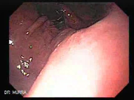 Presence of Multiple Irregular and Large Ulcers - Quick Look at the Lesions