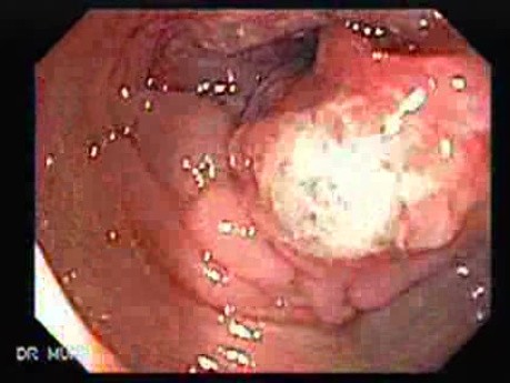 Adenocarcinoma of the Transverse Colon (1 of 5)