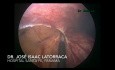 Cystic Intestinal Pneumatosis - Differential Diagnosis of Acute Abdomen