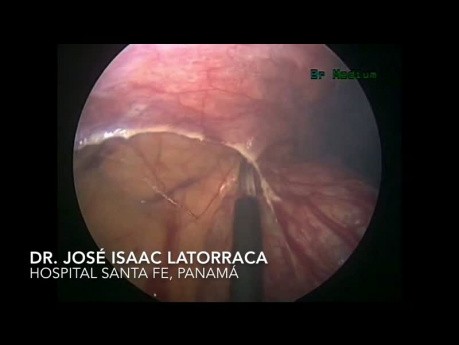Cystic Intestinal Pneumatosis - Differential Diagnosis of Acute Abdomen