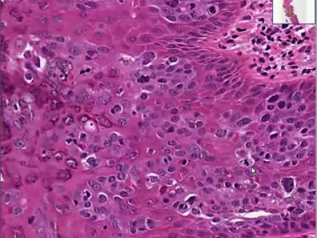Arsenical keratosis