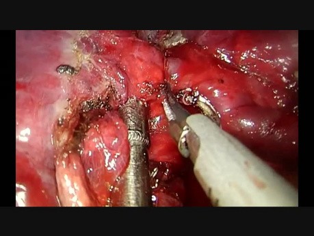 Uniportal VATS left anatomic combined segmentectomy S3+S4+S5