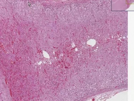 Cortical adenoma - Histopathology - Adrenal