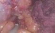 Band to Sleeve Gastrectomy 