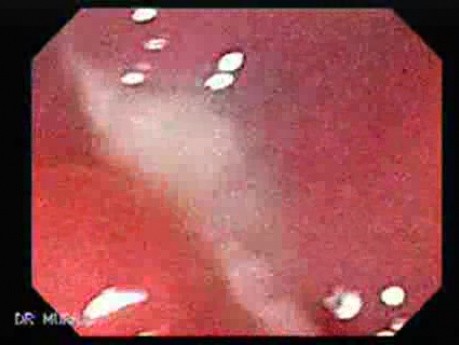Inespecific Diverticulitis (1 of 4)