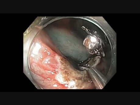 Colonoscopy Channel - EMR Closure (8-2 O'Clock)