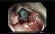 Colonoscopy Channel - EMR on a Flat Lesion on Antithrombotics