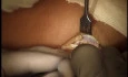ORIF Intra-Articular Radial Head Fracture Surgery