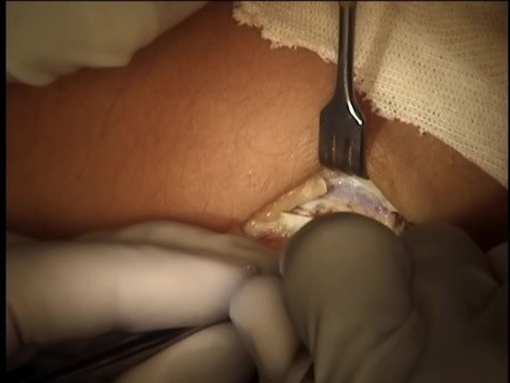 ORIF Intra-Articular Radial Head Fracture Surgery