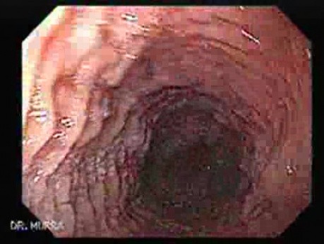 Eosinophilic Esophagitis - Linear Furrows