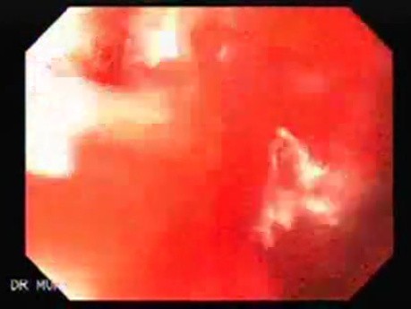 Synchronous Cancer Gastric and Esophageal(9 of 9 )