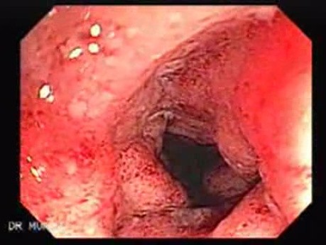 Colitis Ulcerosa - Pseudopolyps (5 of 22)