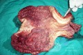 Endoscopy of Scirrhous Gastric Carcinoma involving the entire Fundus, Body and the Antrum (29 of 47)