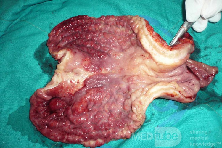 Endoscopy of Scirrhous Gastric Carcinoma involving the entire Fundus, Body and the Antrum (29 of 47)