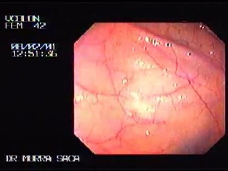 Lymphoid hyperplasia
