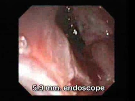 Adenocarcinoma of the Gastroesophageal Junction - Esophagus-Hernia Fistula, Part 1