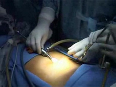 Total Extra Peritoneal (TEP) in 10 steps - Part 2