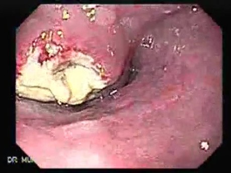 Small cell carcinoma of the lung that invades the upper and the middle third of the Esophagus (3 of 7)