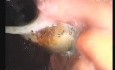 Silicone Gastric Band (Clamp) Migration
