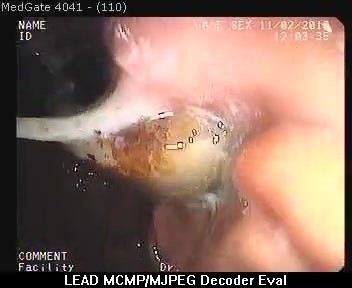 Silicone Gastric Band (Clamp) Migration