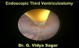 Endoscopic 3Rd Ventriculostomy