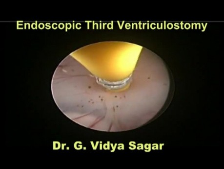 Endoscopic 3Rd Ventriculostomy