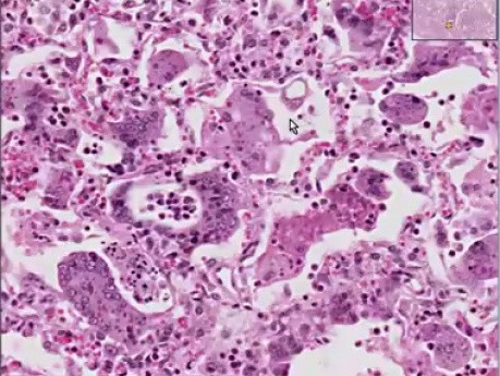 Measles pneumonia
