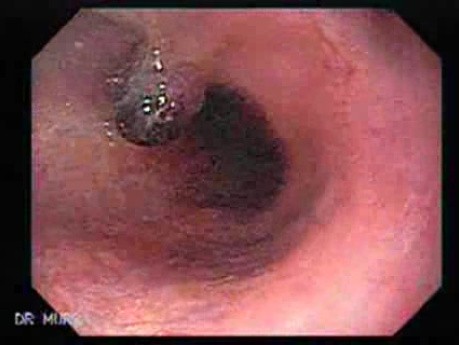 Long Standing Alcohol Abuse - Banded Varices At the Middle Third of Esophagus