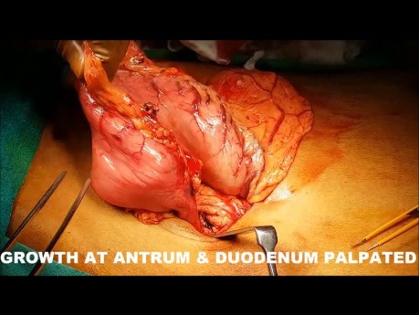 Laparoscopic Assisted Distal Radical Gastrectomy