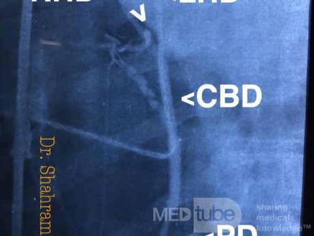 Junction of the Cystic Duct to Right Hepatic Duct