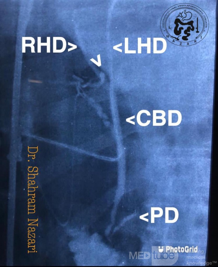 Junction of the Cystic Duct to Right Hepatic Duct