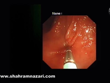 Clip Closure Prevents Bleeding After Endoscopic Resection of Large Colon Polyps