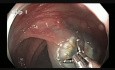 Transverse Colon - Flat Lesion - Enbloc Resection - unedited video